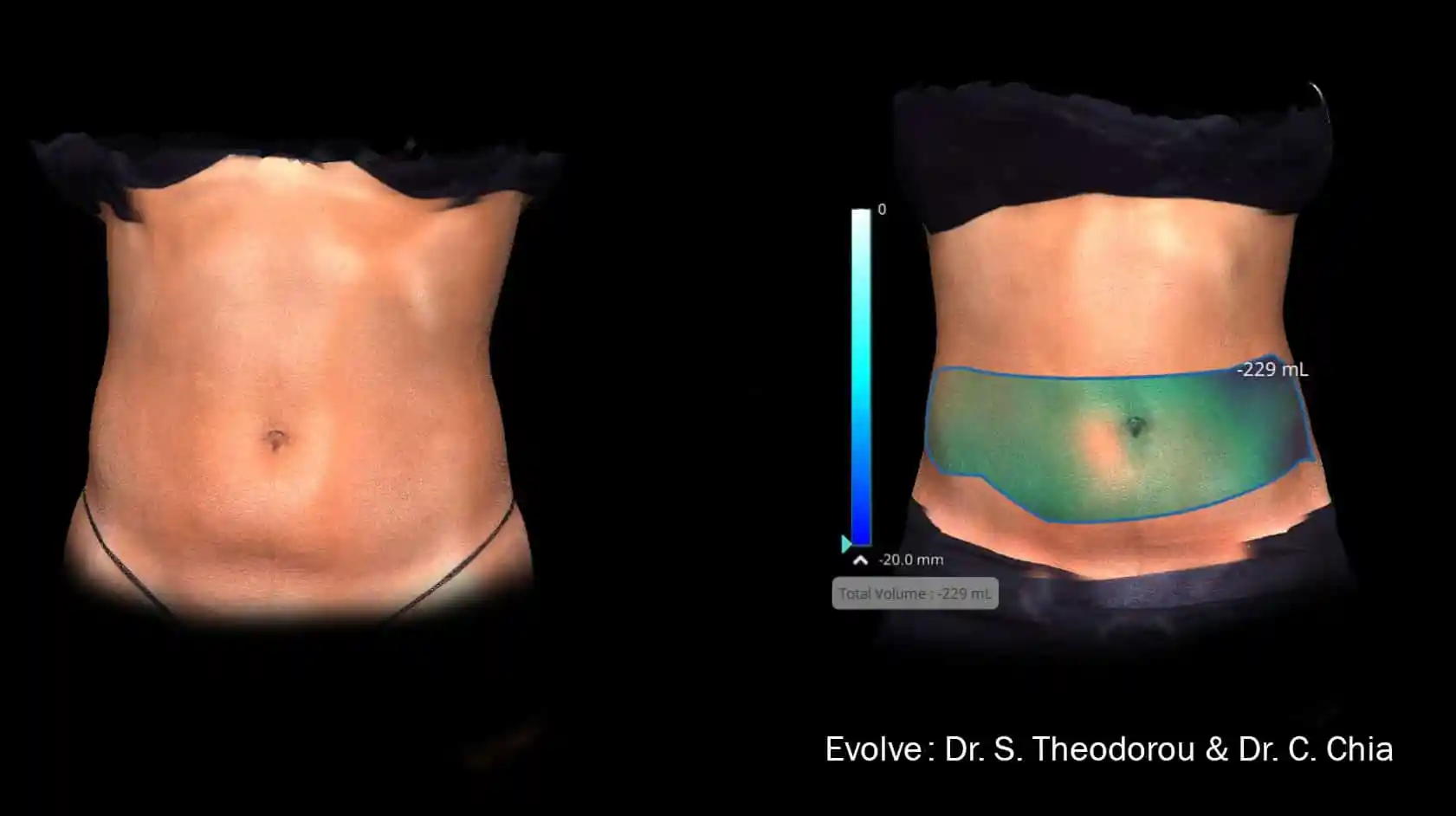 Before and After EvolveX Treatment Results of a woman tummy area | Aspen Prime Med Spa in Hoboken, NJ