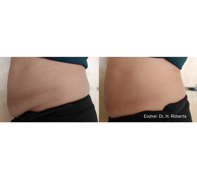 EvolveX treatment Before and After Image | Aspen Prime Med Spa in Hoboken, NJ