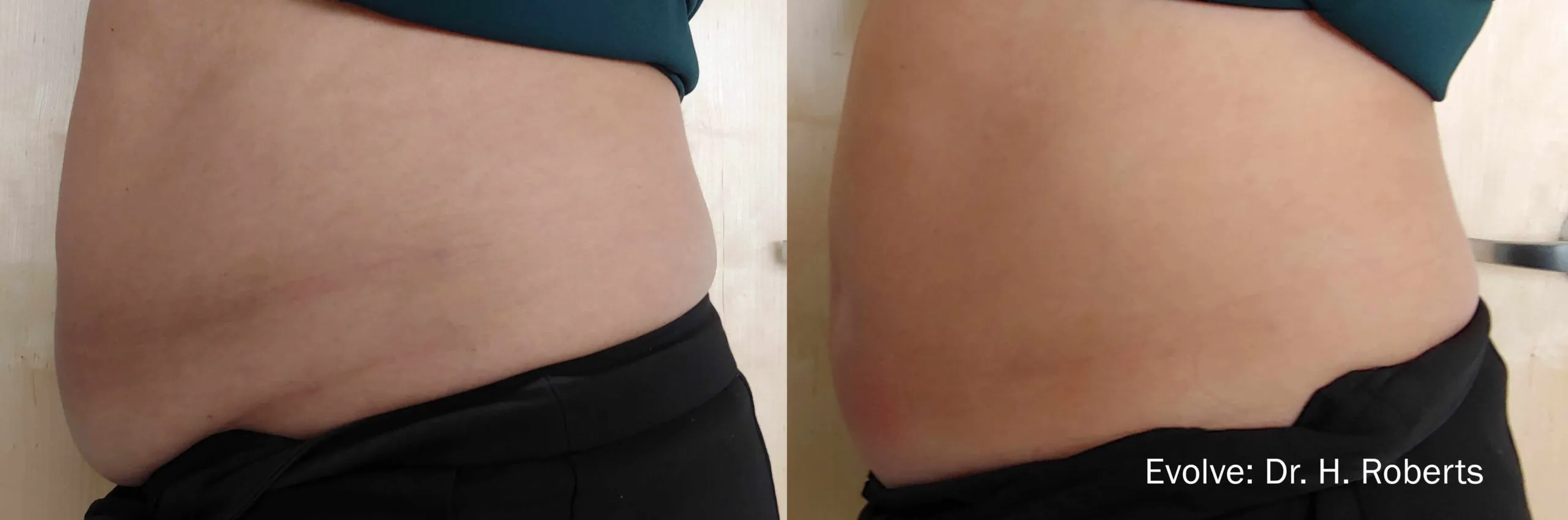 Before and After EvolveX Treatment Results of a woman tummy area | Aspen Prime Med Spa in Hoboken, NJ