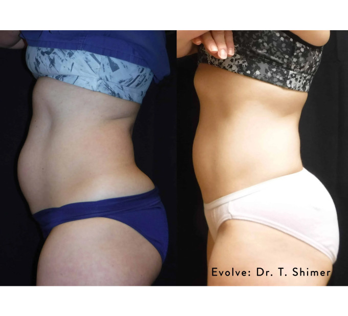 EvolveX treatment Before and After Image | Aspen Prime Med Spa in Hoboken, NJ