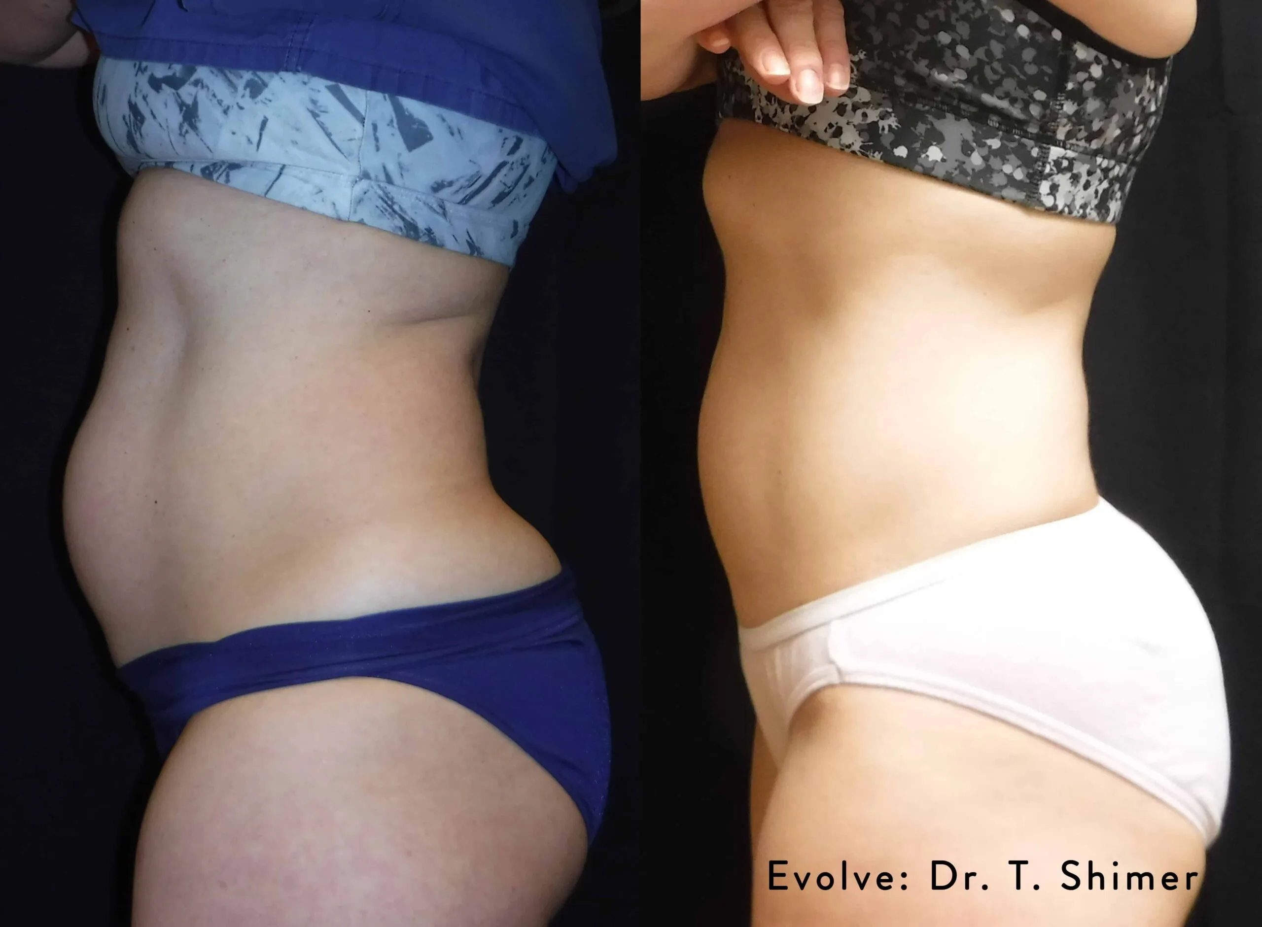Before and After EvolveX Treatment Results of a woman tummy area | Aspen Prime Med Spa in Hoboken, NJ