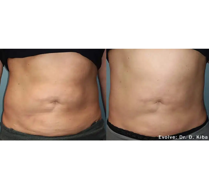 EvolveX treatment Before and After Image | Aspen Prime Med Spa in Hoboken, NJ
