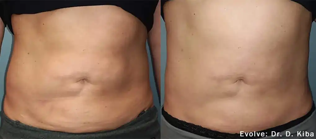 Before and After EvolveX Treatment Results on the tummy area | Aspen Prime Med Spa in Hoboken, NJ