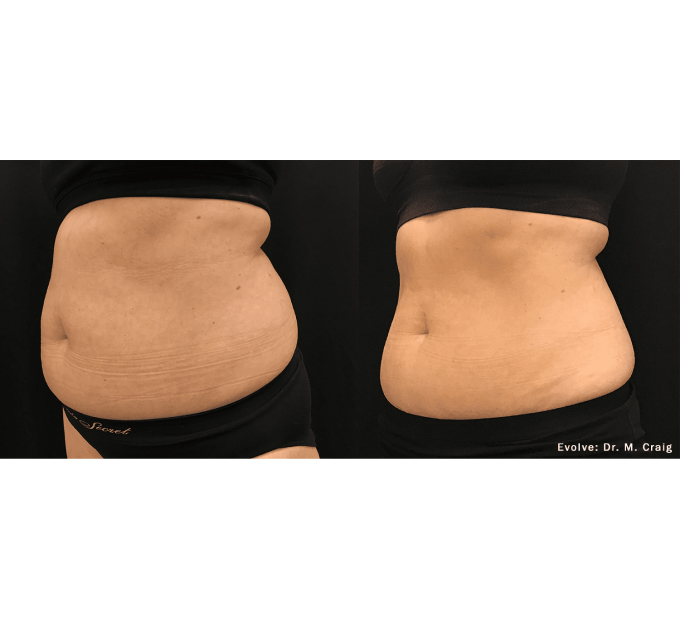 EvolveX treatment Before and After Image | Aspen Prime Med Spa in Hoboken, NJ