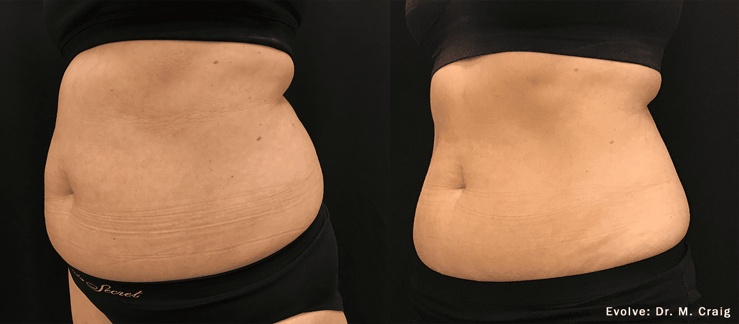Before and After EvolveX Treatment Results of a woman tummy area | Aspen Prime Med Spa in Hoboken, NJ