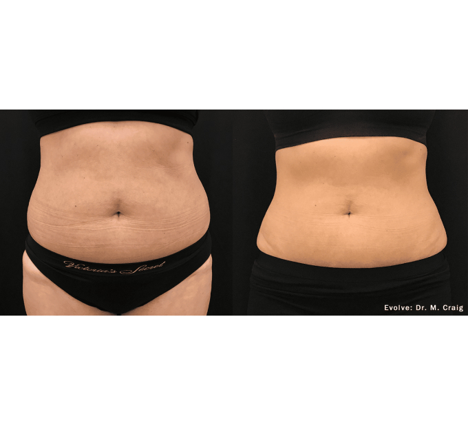 EvolveX treatment Before and After Image | Aspen Prime Med Spa in Hoboken, NJ