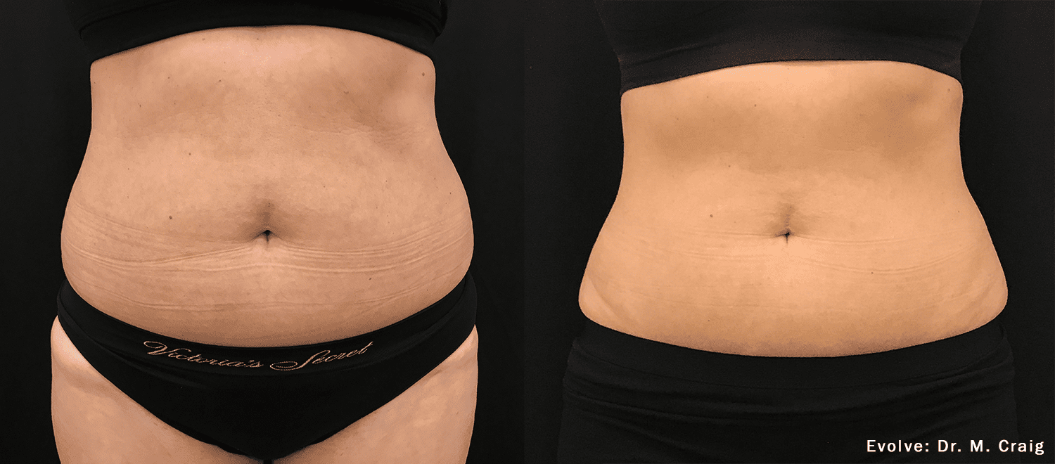 Before and After EvolveX Treatment Results of a woman tummy area | Aspen Prime Med Spa in Hoboken, NJ