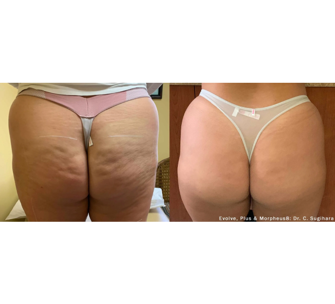EvolveX treatment Before and After Image | Aspen Prime Med Spa in Hoboken, NJ