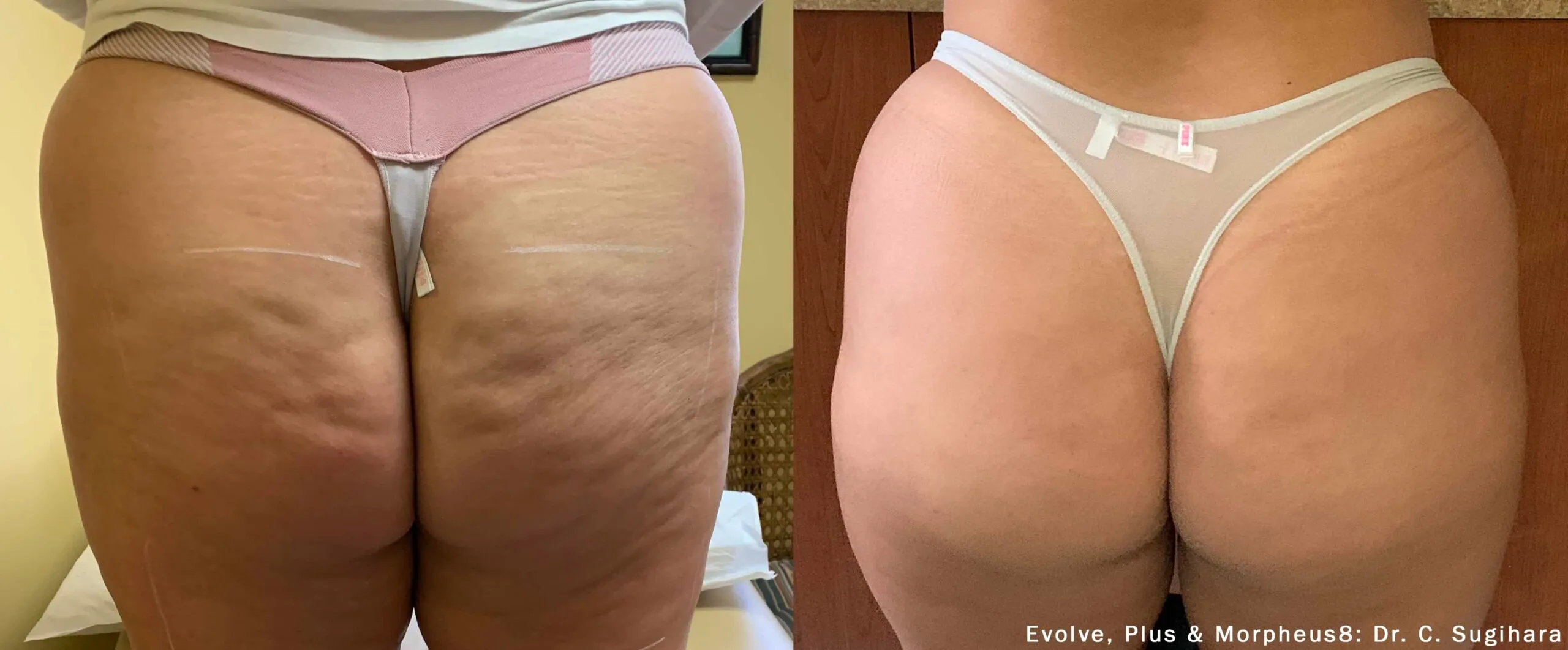 Before and After EvolveX Treatment Results of a woman Buttocks | Aspen Prime Med Spa in Hoboken, NJ
