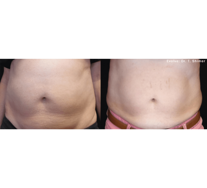 EvolveX treatment Before and After Image | Aspen Prime Med Spa in Hoboken, NJ