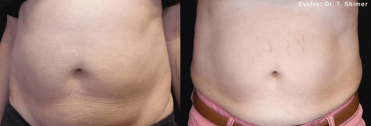 Before and After EvolveX Treatment Results on the tummy area | Aspen Prime Med Spa in Hoboken, NJ