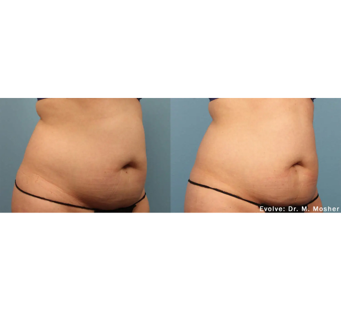 EvolveX treatment Before and After Image | Aspen Prime Med Spa in Hoboken, NJ