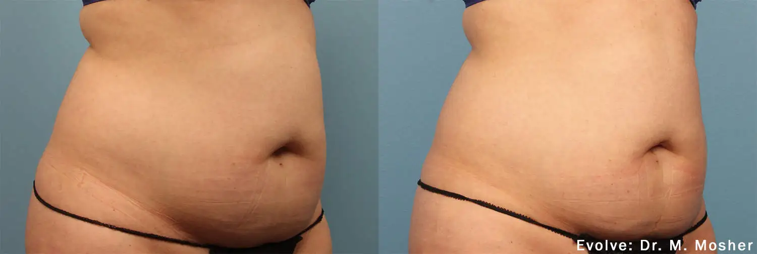Before and After EvolveX Treatment Results of a woman tummy area | Aspen Prime Med Spa in Hoboken, NJ