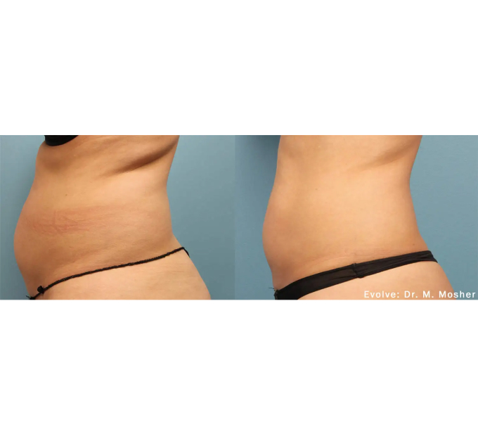 EvolveX treatment Before and After Image | Aspen Prime Med Spa in Hoboken, NJ