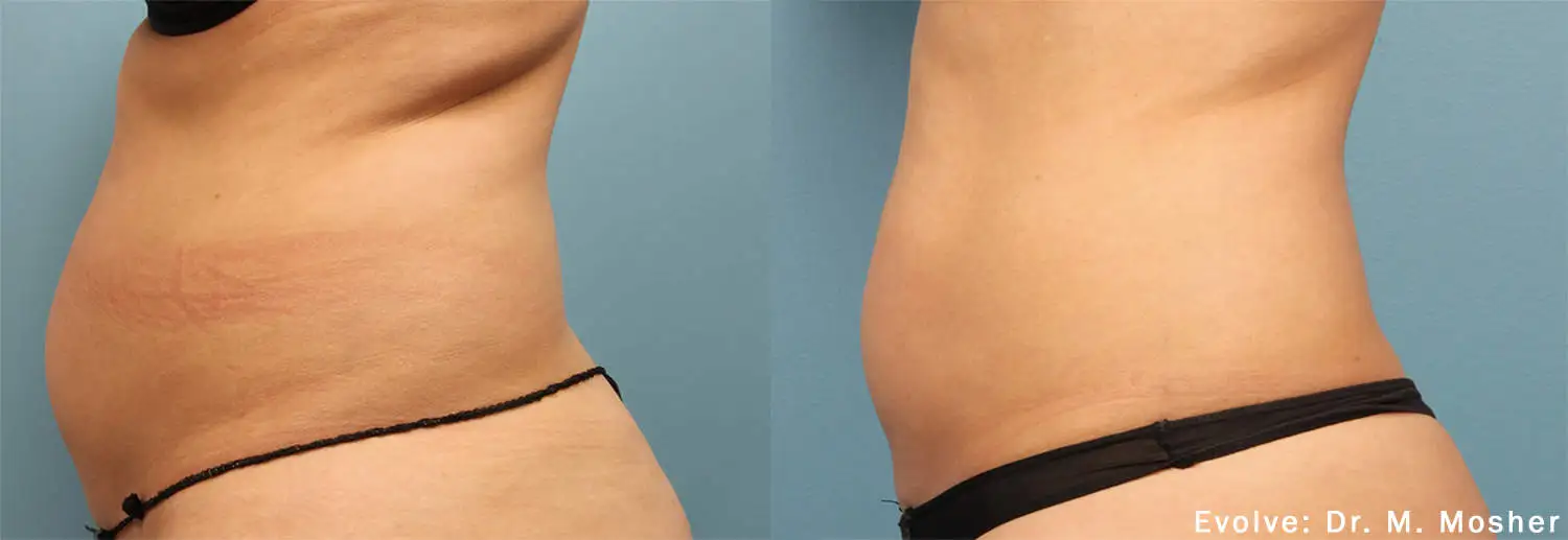 Before and After EvolveX Treatment Results of a woman tummy area | Aspen Prime Med Spa in Hoboken, NJ