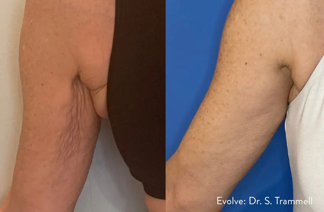 Before and After EvolveX Treatment Results of a Man Arms | Aspen Prime Med Spa in Hoboken, NJ