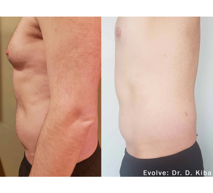 EvolveX treatment Before and After Image | Aspen Prime Med Spa in Hoboken, NJ