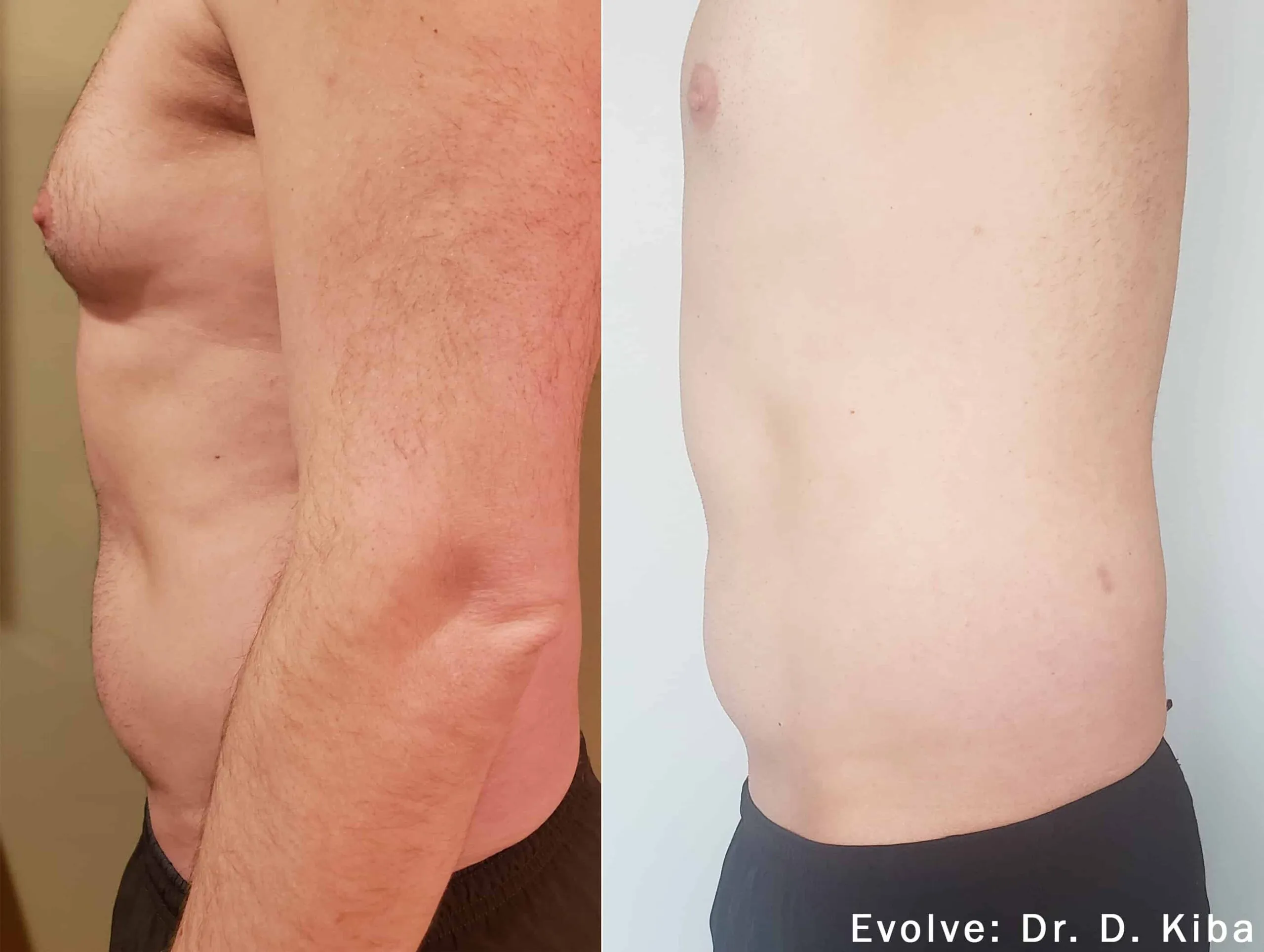 EvolveX Treatment Before and After Image | Aspen Prime Med Spa in Hoboken, NJ