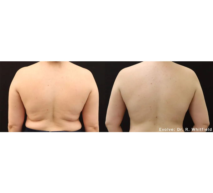 EvolveX treatment Before and After Image | Aspen Prime Med Spa in Hoboken, NJ