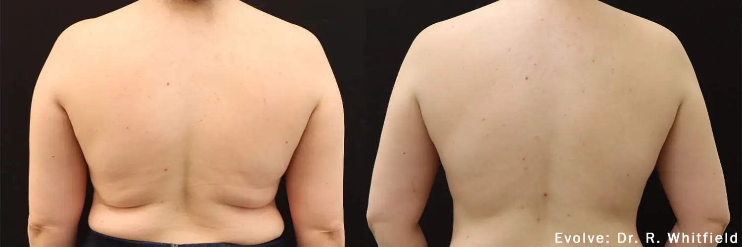 EvolveX Treatment Before and After Image | Aspen Prime Med Spa in Hoboken, NJ