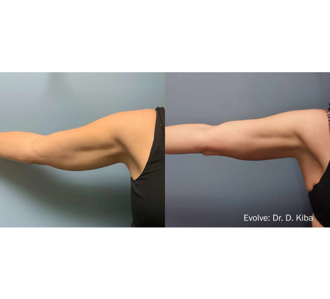 EvolveX treatment Before and After Image | Aspen Prime Med Spa in Hoboken, NJ