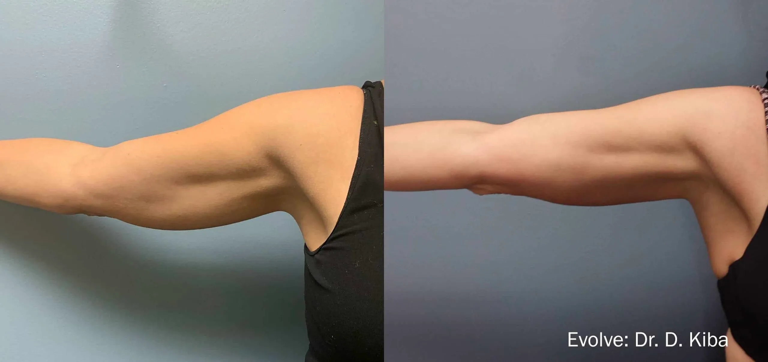 EvolveX Treatment Before and After Image | Aspen Prime Med Spa in Hoboken, NJ