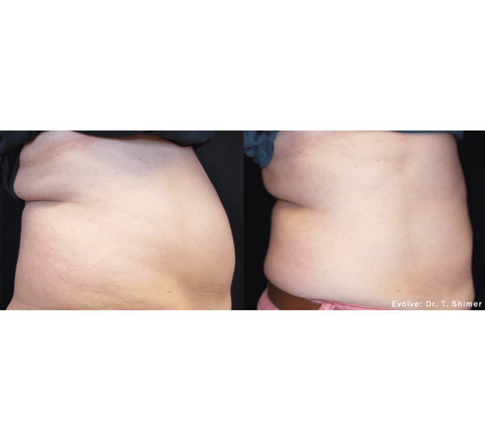 EvolveX treatment Before and After Image | Aspen Prime Med Spa in Hoboken, NJ