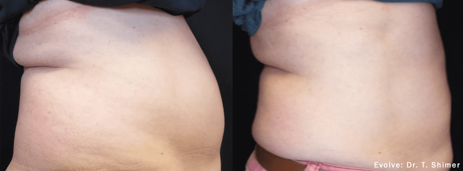 EvolveX Treatment Before and After Image | Aspen Prime Med Spa in Hoboken, NJ