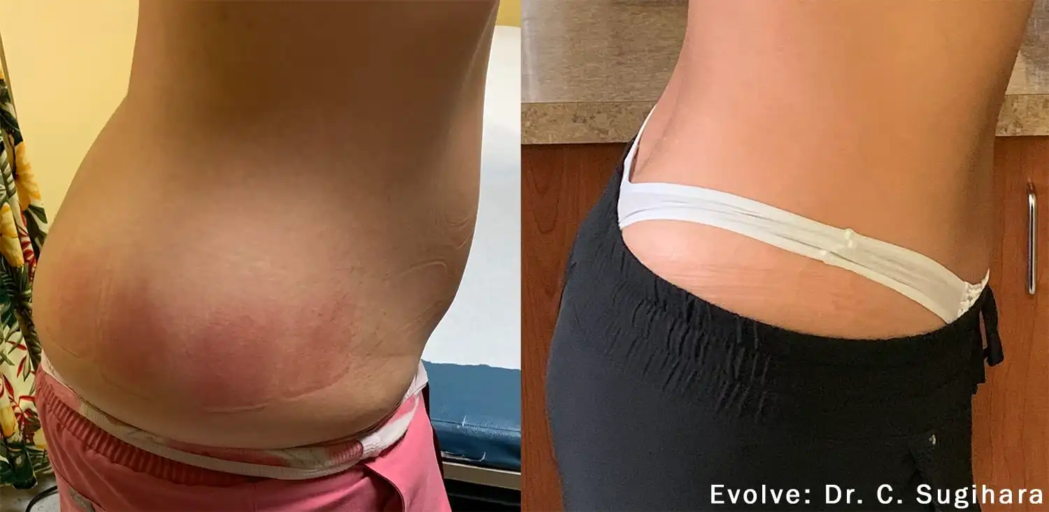 EvolveX Treatment Before and After Image | Aspen Prime Med Spa in Hoboken, NJ