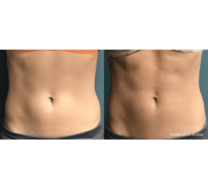 EvolveX treatment Before and After Image | Aspen Prime Med Spa in Hoboken, NJ
