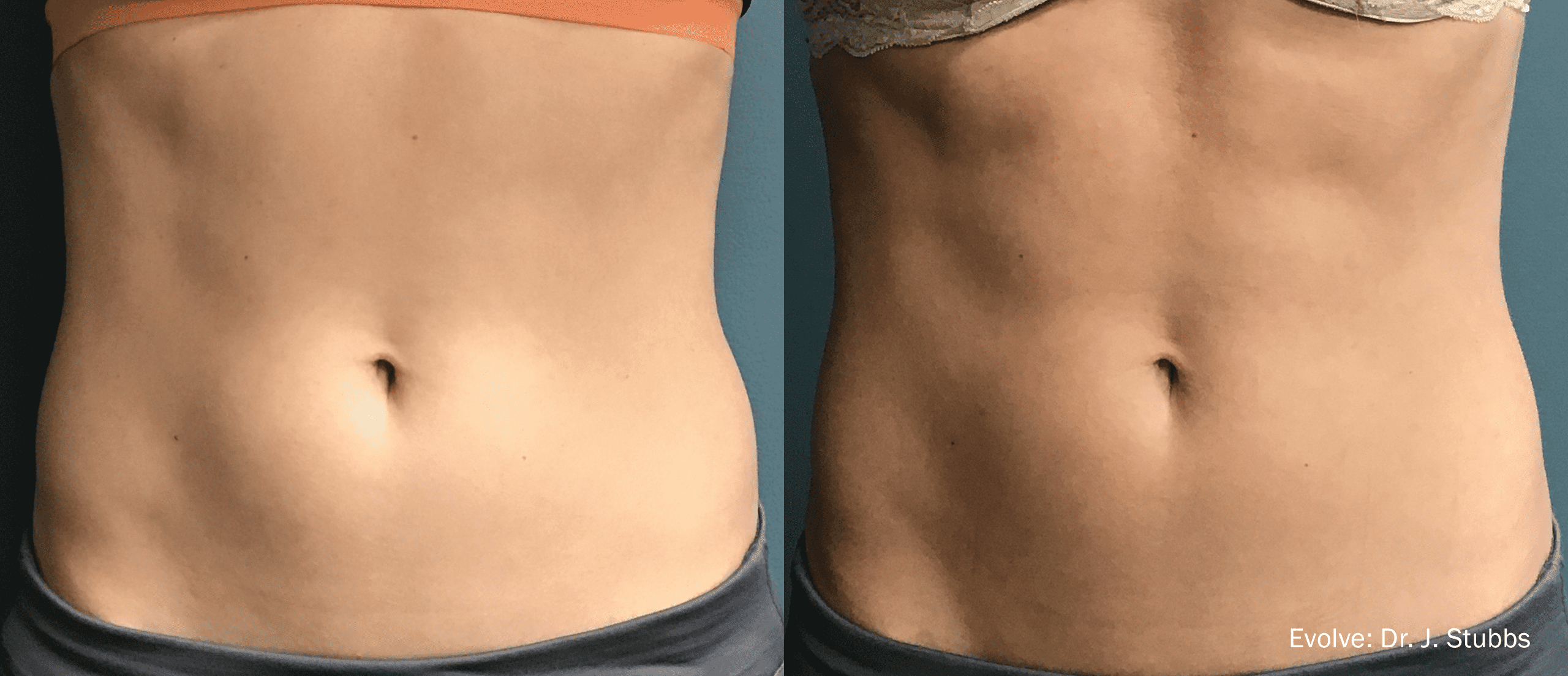 EvolveX Treatment Before and After Image | Aspen Prime Med Spa in Hoboken, NJ