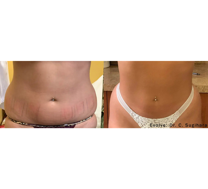 EvolveX treatment Before and After Image | Aspen Prime Med Spa in Hoboken, NJ