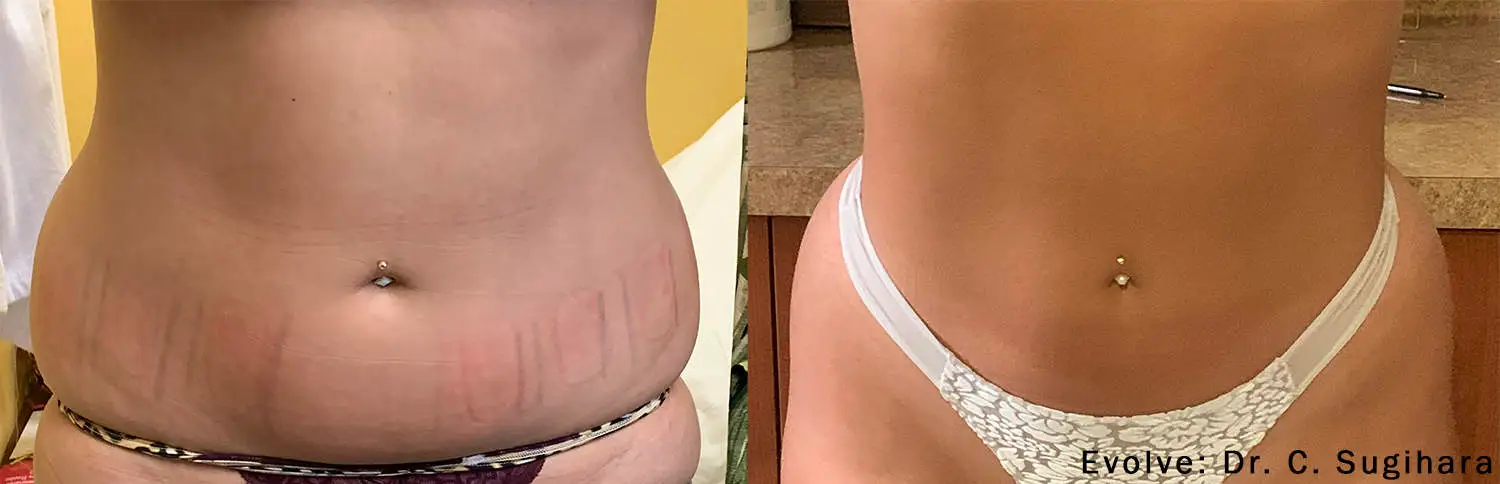 EvolveX Treatment Before and After Image | Aspen Prime Med Spa in Hoboken, NJ