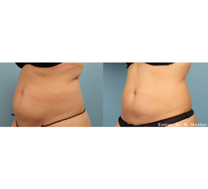 EvolveX treatment Before and After Image | Aspen Prime Med Spa in Hoboken, NJ