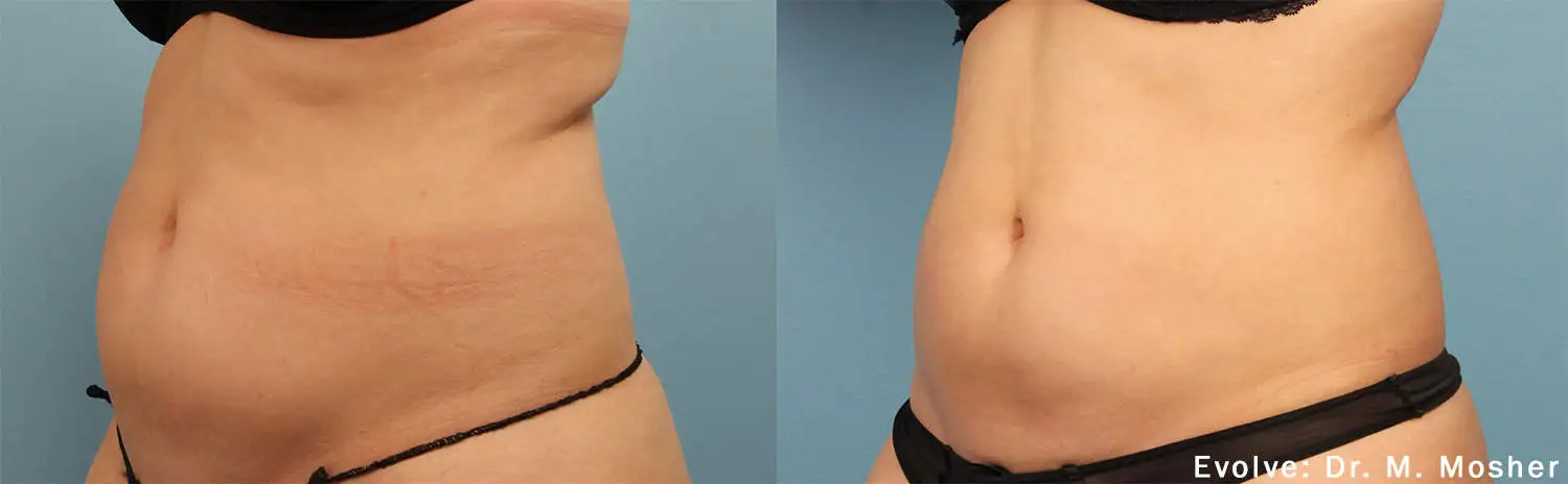EvolveX Treatment Before and After Image | Aspen Prime Med Spa in Hoboken, NJ