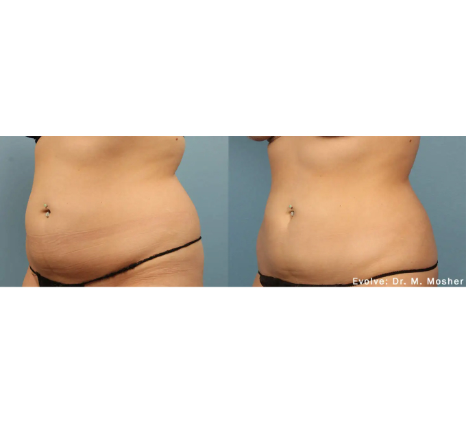 EvolveX treatment Before and After Image | Aspen Prime Med Spa in Hoboken, NJ