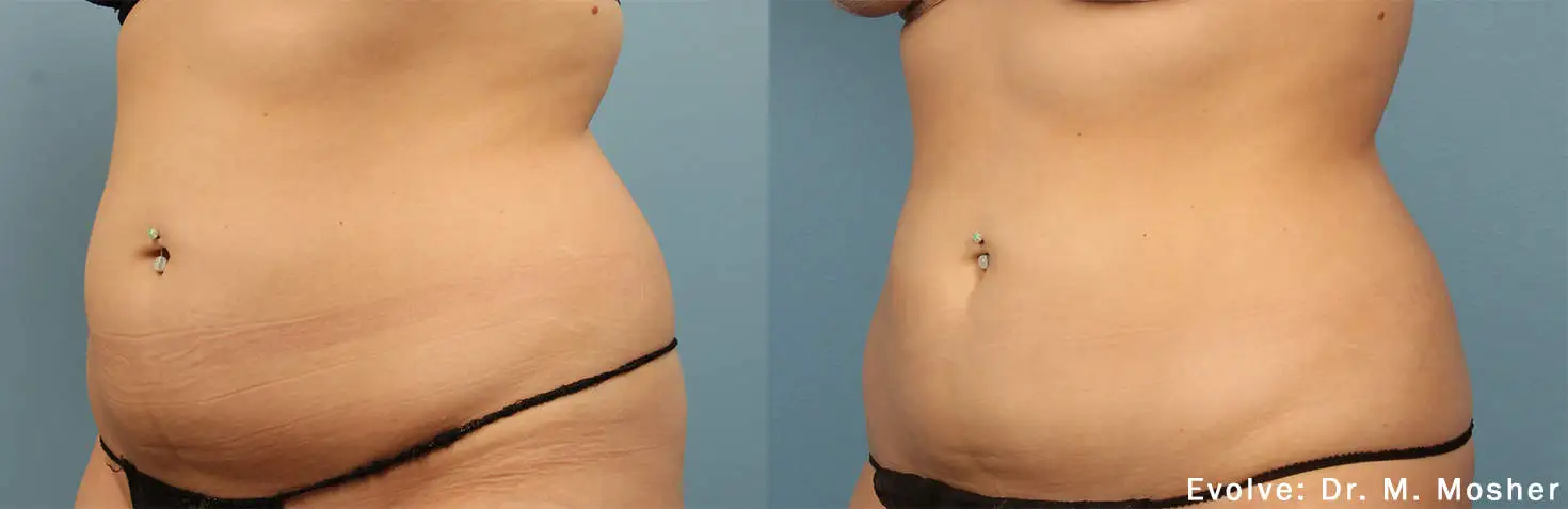 EvolveX Treatment Before and After Image | Aspen Prime Med Spa in Hoboken, NJ