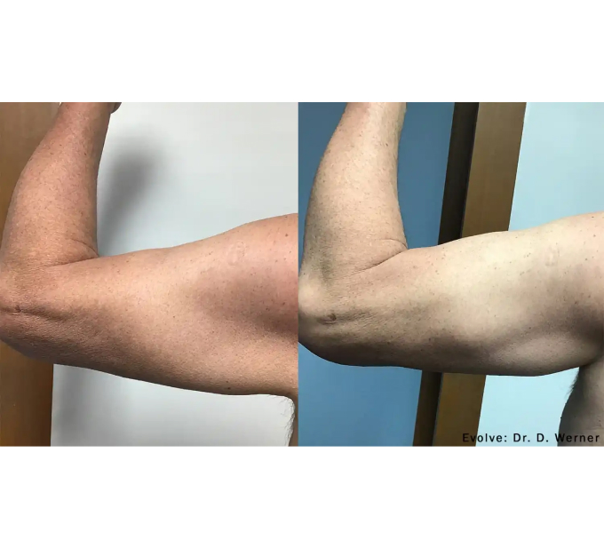 EvolveX treatment Before and After Image | Aspen Prime Med Spa in Hoboken, NJ