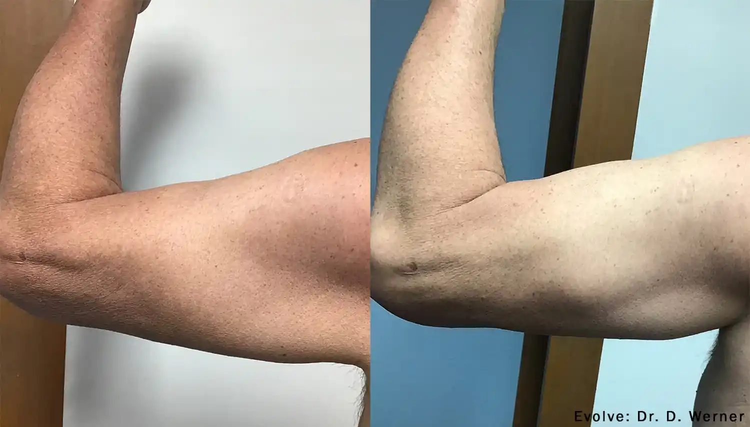 EvolveX Treatment Before and After Image | Aspen Prime Med Spa in Hoboken, NJ