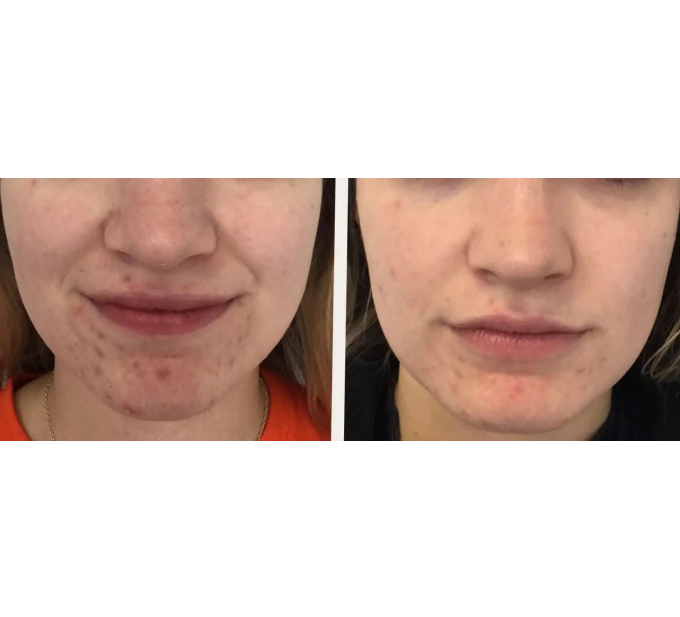 JetPeel Treatment Before and After Image | Aspen Prime Med Spa in Hoboken, NJ