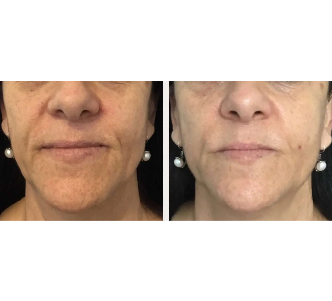 JetPeel Treatment Before and After Image | Aspen Prime Med Spa in Hoboken, NJ