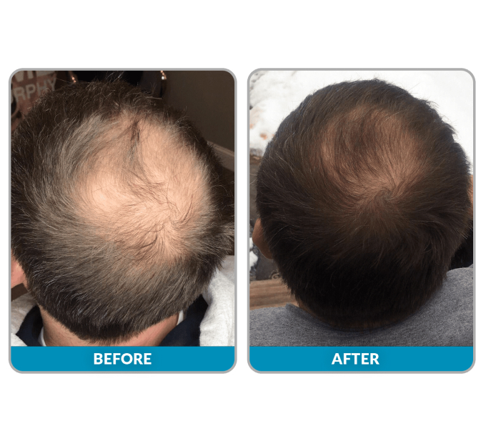 JetPeel Treatment Before and After Image | Aspen Prime Med Spa in Hoboken, NJ