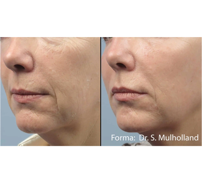 Old Female Face Before and After Forma treatments | Aspen Prime Med Spa in Hoboken, NJ