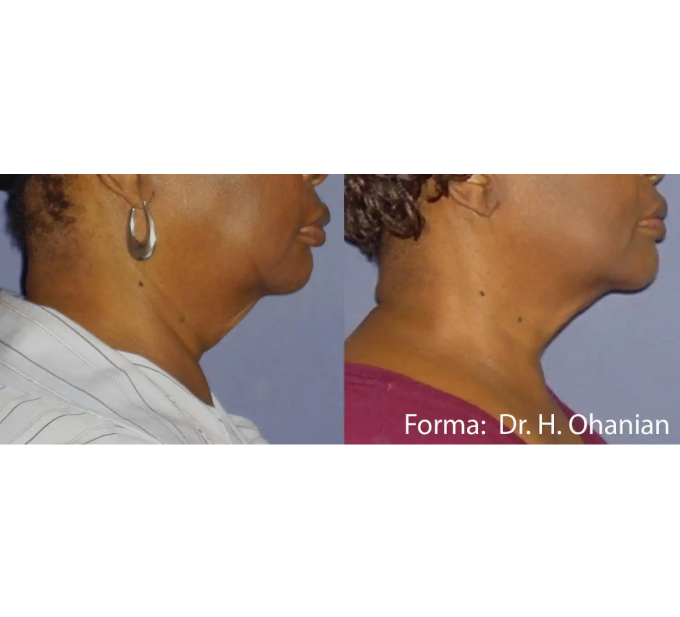 Old Female Face Before and After Forma treatments | Aspen Prime Med Spa in Hoboken, NJ
