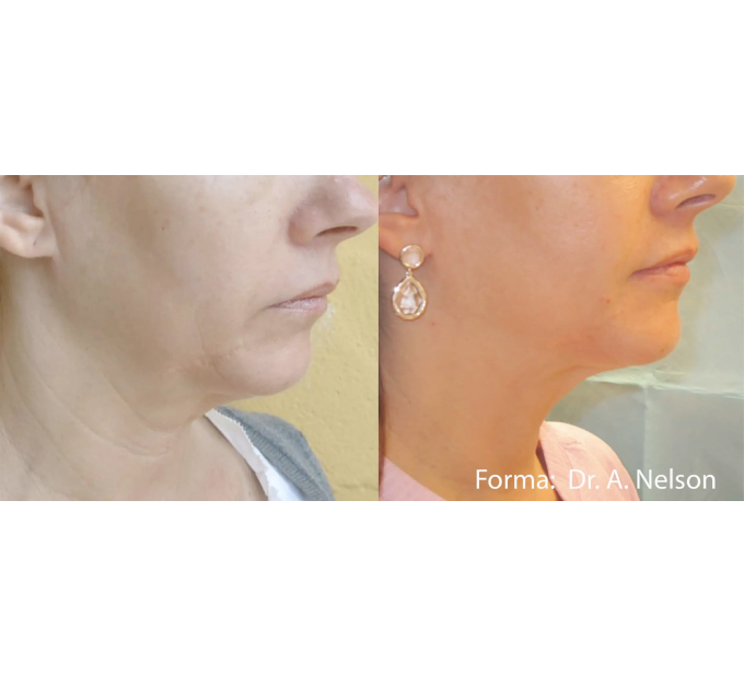 Old Female Face Before and After Getting Forma Skin Tightening treatments | Aspen Prime Med Spa in Hoboken, NJ