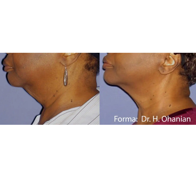 Young Female Face Before and After Getting Forma Skin Tightening treatments | Aspen Prime Med Spa in Hoboken, NJ