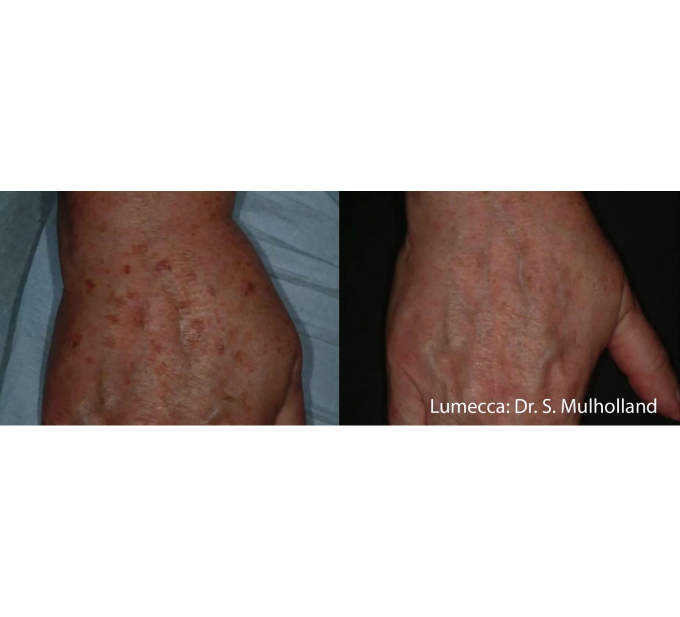 Old Female Hand Before and After Getting Lumecca IPL Photofacial treatments | Aspen Prime Med Spa in Hoboken, NJ