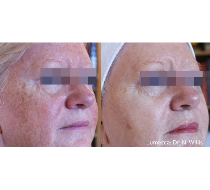 Old Female Before and After Getting Lumecca IPL Photofacial treatments | Aspen Prime Med Spa in Hoboken, NJ
