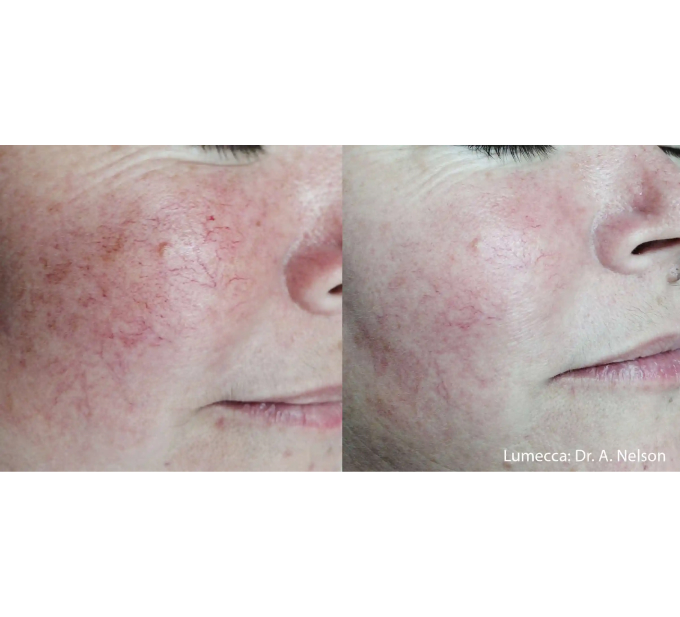 Old Female Before and After Getting Lumecca IPL Photofacial treatments | Aspen Prime Med Spa in Hoboken, NJ
