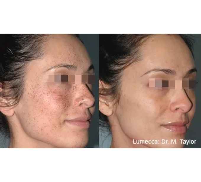 Young Female Before and After Getting Lumecca IPL Photofacial treatments | Aspen Prime Med Spa in Hoboken, NJ